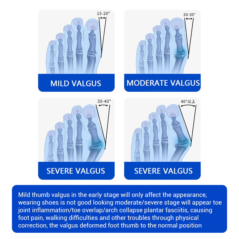 Ajustador de Juanetes, Correct - Toe Separator Silicon reseña y precio